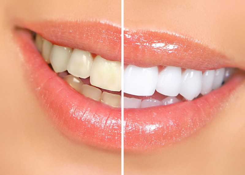 Teeth Whitening  Plano, TX 